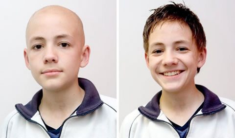 Alopecia Children
