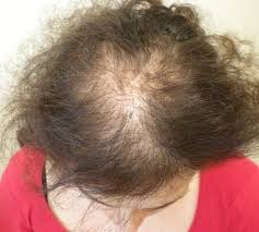 female Hair Loss