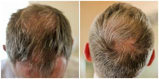 male pattern baldness treatment brisbane, Are you at your wit’s end trying to male pattern baldness treatment Brisbane?