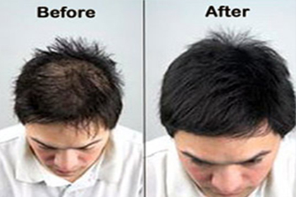  hair loss treatment