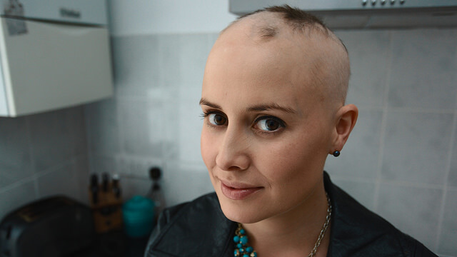 Alopecia Sufferer - Complete loss of Hair