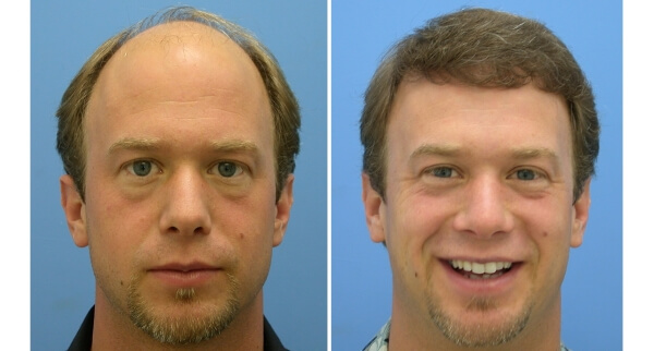 is hair transplant right for you, Is Hair Transplant Right For You?