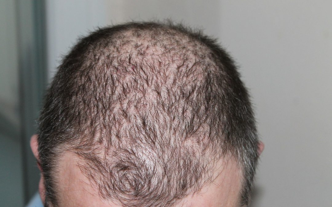 Example of thin hair needing regrowth Brisbane