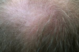 natural hair transplant alternatives brisbane