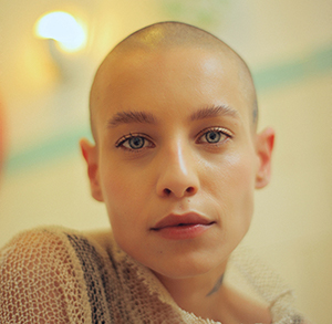 causes of alopecia, Causes of Alopecia Hair Loss