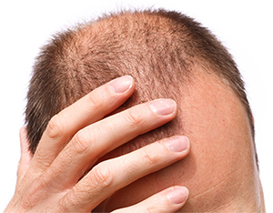 at home hair loss treatments aren’t as strong