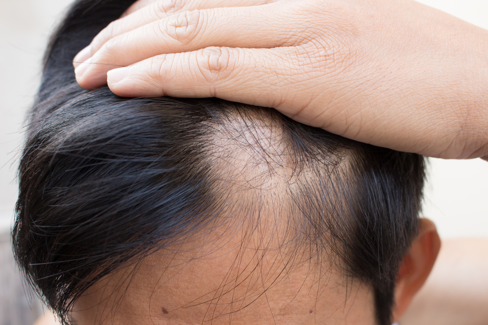 ongoing hair loss treatment, How should you explain to people that you have a hair loss condition