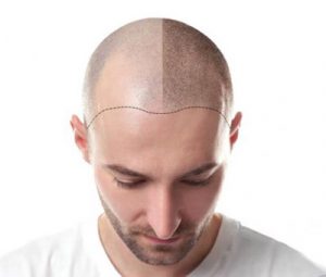 scalp micropigmentation brisbane